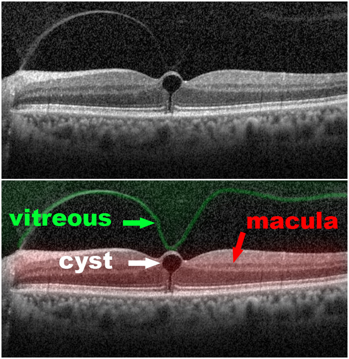 Vitreomacular Traction | Scott E. Pautler, M.D. Tampa