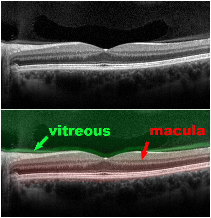 Vitreomacular Traction Syndrome - Scott E. Pautler, M.D. TampaScott E ...